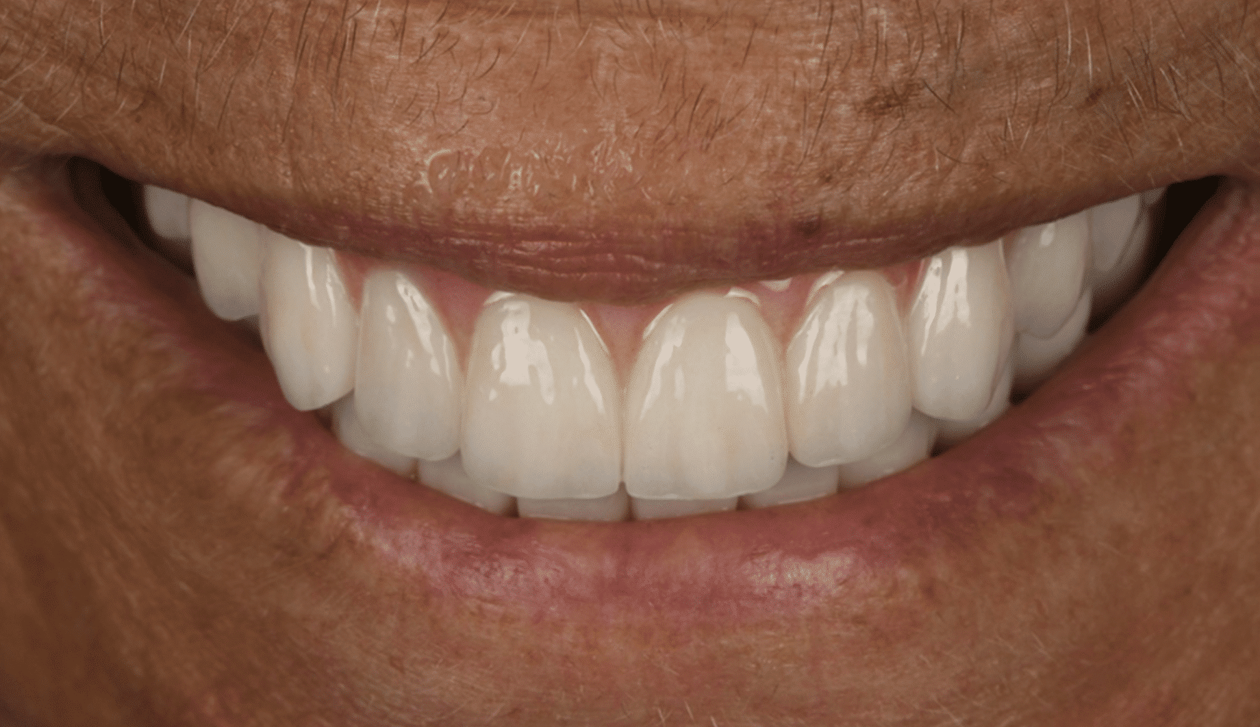 יישור שיניים מהיר - מה הן השיטות?